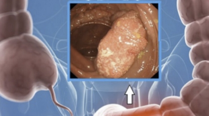 8 dấu hiệu cảnh báo sớm ung thư đại trực tràng